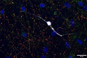 human Down syndrome stem cell derived neuron immunostained to identify synapses.