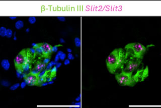  images of intrapancreatic ganglia (parasympathetic 
 
neurons located in the pancreas), 

 labeled in green by beta tubulin III (a pan-neuronal marker). 

 In magenta is expression of Slit2 and Slit3 (Slit2/3) mRNA within 

 the intrapancreatic ganglia. Scale bar is 50um. (Blum Lab)
