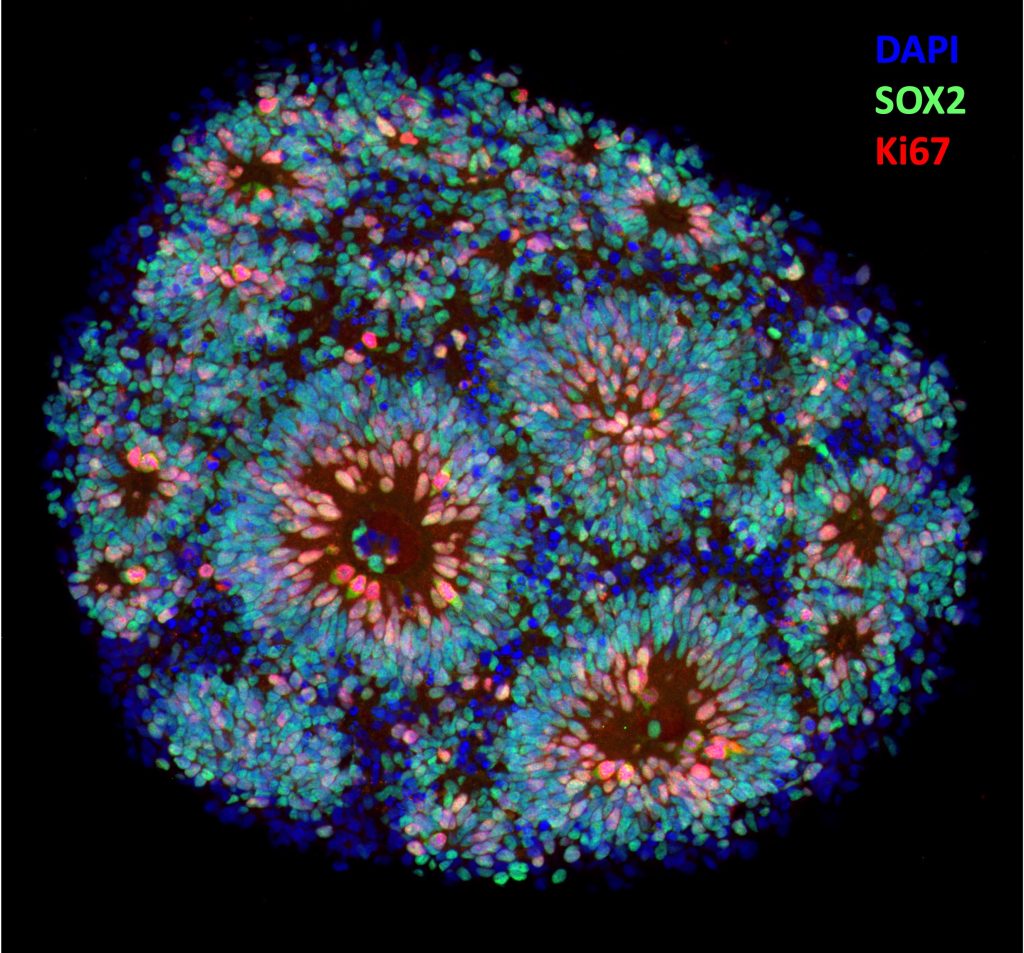 An iPSC derived brain organoid immunostained to show neural progenitors.